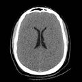 Atlanto-occipital dislocation (Radiopaedia 44648-48412 Axial non-contrast 34).jpg