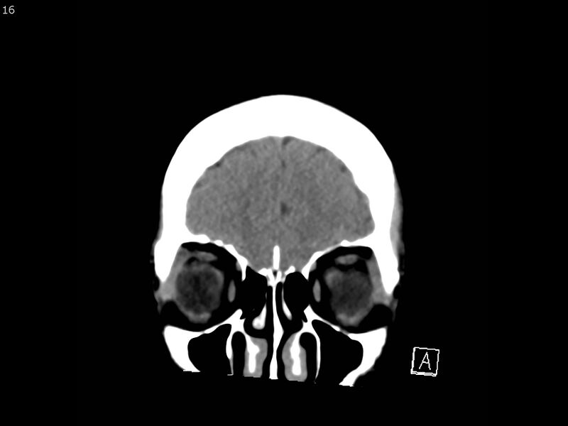 File:Atypical meningioma - intraosseous (Radiopaedia 64915-73867 B 15).jpg