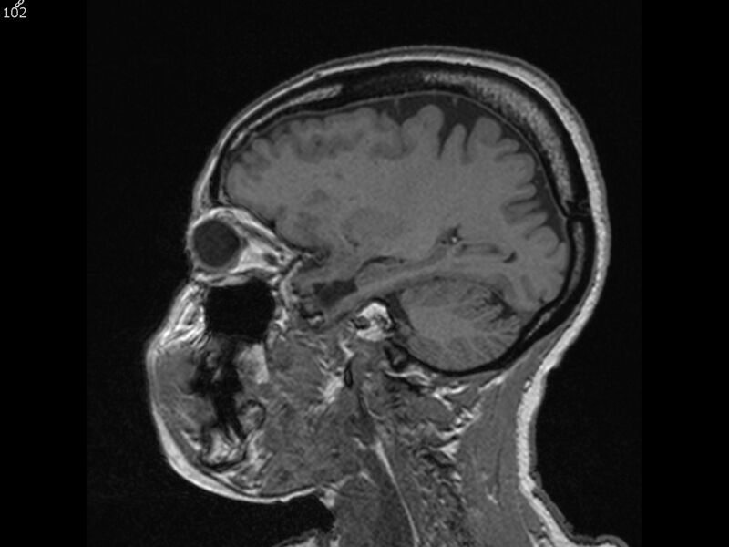 File:Atypical meningioma - intraosseous (Radiopaedia 64915-74572 Sagittal T1 102).jpg