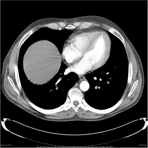File:Atypical pneumonia - Q fever (Radiopaedia 21993-21989 C+ arterial phase 33).jpg