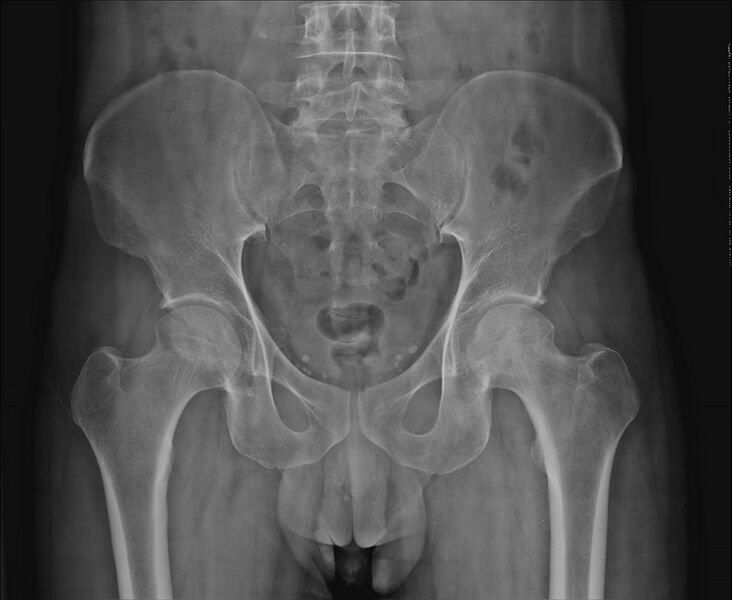 File:Avascular necrosis of the hip (Radiopaedia 19048).jpg