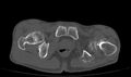 Avascular necrosis of the left hip (Radiopaedia 75068-86125 Axial bone window 78).jpg