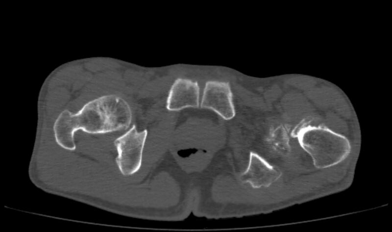 File:Avascular necrosis of the left hip (Radiopaedia 75068-86125 Axial bone window 78).jpg