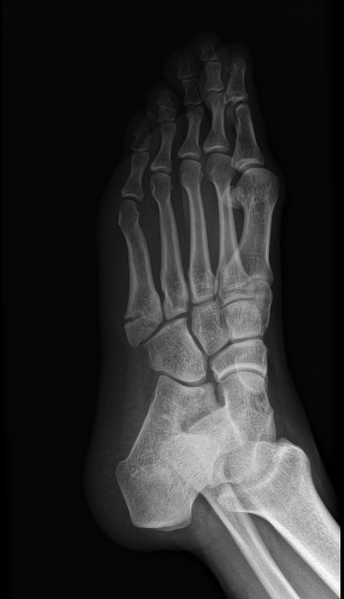 File:Avulsion fracture of the 5th metatarsal styloid - pseudo-Jones fracture (Radiopaedia 61218-69121 Oblique 1).PNG