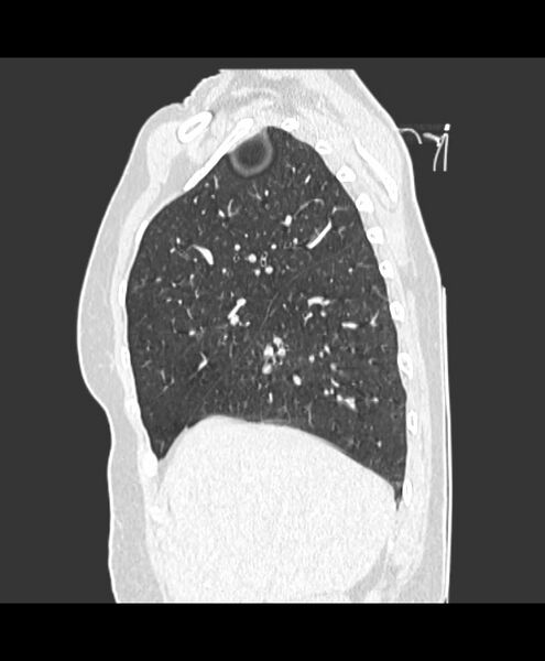File:Azygos fissure and azygos lobe (Radiopaedia 41841-44832 Sagittal lung window 2).jpg