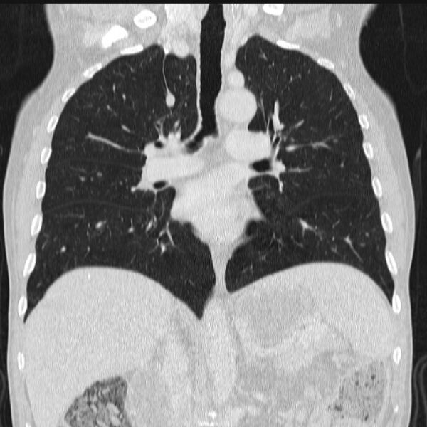 File:Azygos lobe (Radiopaedia 38259-40275 Coronal lung window 43).jpg