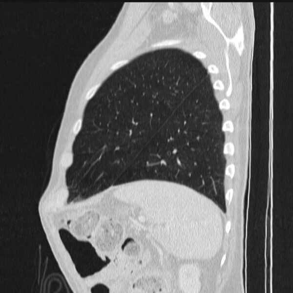 File:Azygos lobe (Radiopaedia 38259-40275 lung window 82).jpg