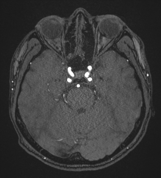 File:Basal ganglia subacute infarct (Radiopaedia 80201-93521 Axial MRA 36).png