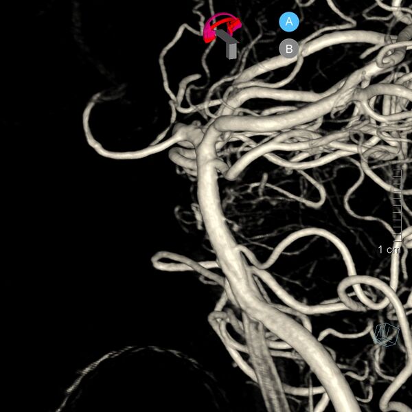 File:Basilar artery perforator aneurysm (Radiopaedia 82455-97734 3D view left VA 28).jpg