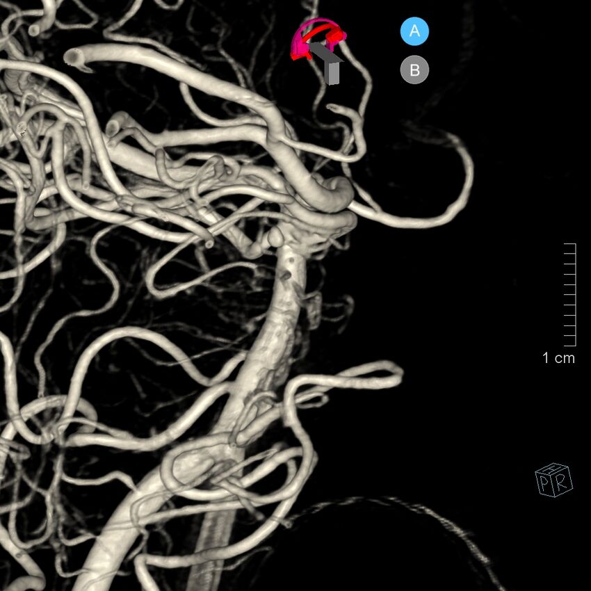 Basilar artery perforator aneurysm (Radiopaedia 82455-97734 3D view left VA 74).jpg
