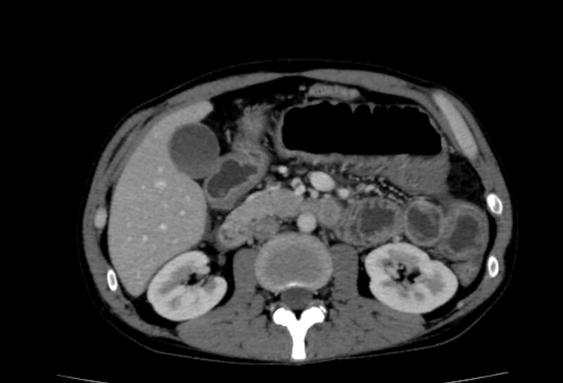 File:Behçet's disease- abdominal vasculitis (Radiopaedia 55955-62570 A 32).jpg