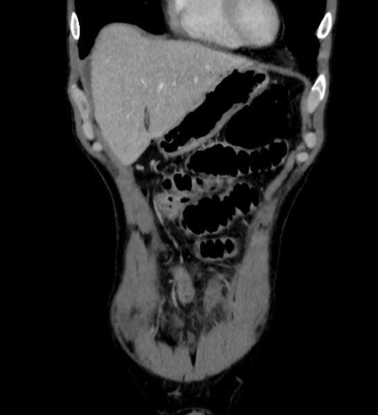 File:Behçet's disease- abdominal vasculitis (Radiopaedia 55955-62570 B 4).jpg
