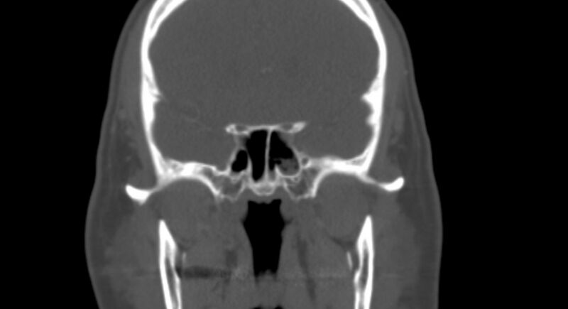 File:Benign mixed salivary tumor of the parotid gland (Radiopaedia 35261-36792 Coronal bone window 13).jpg