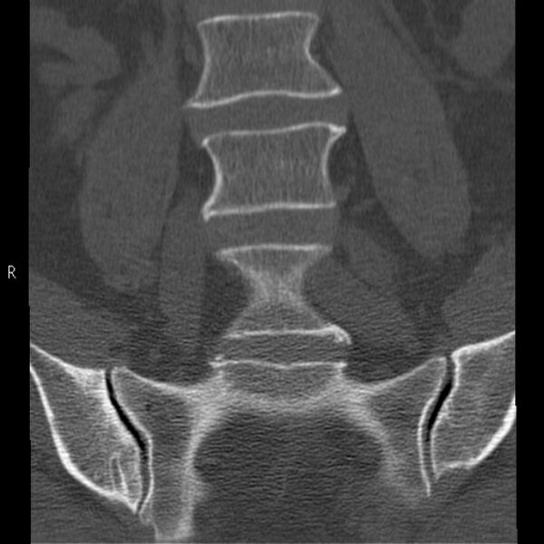 File:Bertolotti syndrome (Radiopaedia 24864-25128 Coronal bone window 13).jpg
