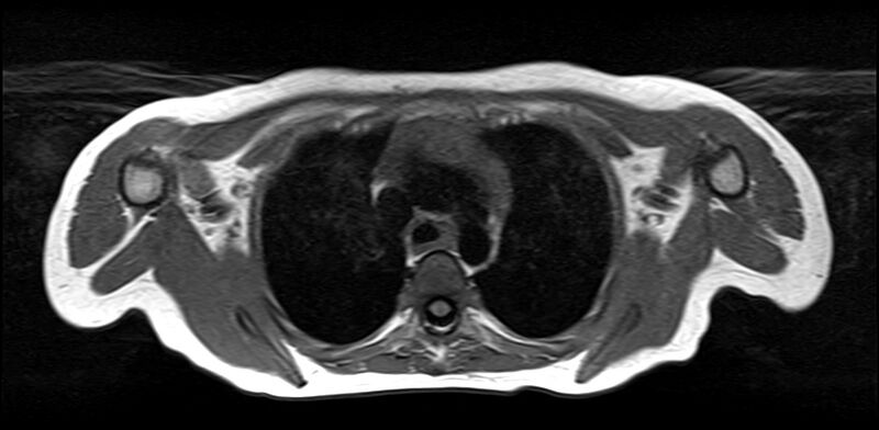 File:Bilateral Sprengel deformity with Klippel-Feil syndrome (Radiopaedia 66395-75650 Axial T1 27).jpg