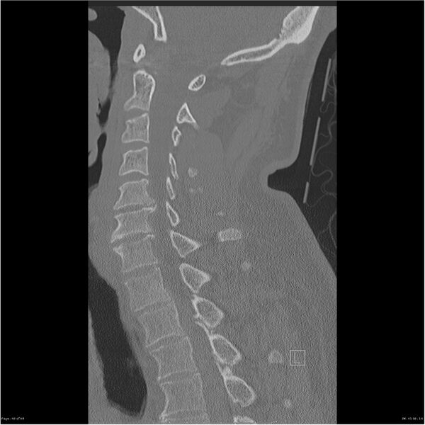 File:Bilateral cervical ribs (Radiopaedia 25868-26017 Sagittal bone window 40).jpg