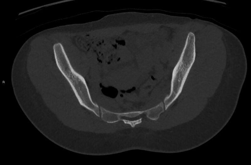 File:Bilateral mature cystic ovarian teratoma (Radiopaedia 88821-105592 Axial bone window 9).jpg