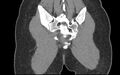 Bilateral mature cystic ovarian teratoma (Radiopaedia 88821-105592 Coronal non-contrast 43).jpg