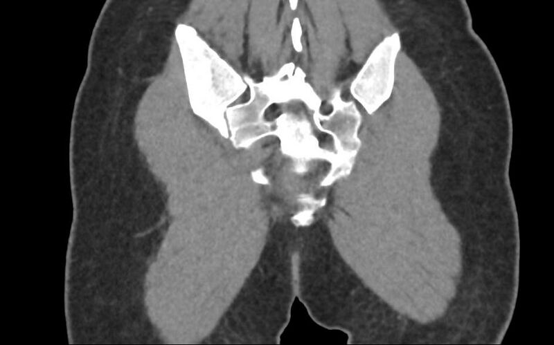 File:Bilateral mature cystic ovarian teratoma (Radiopaedia 88821-105592 Coronal non-contrast 43).jpg