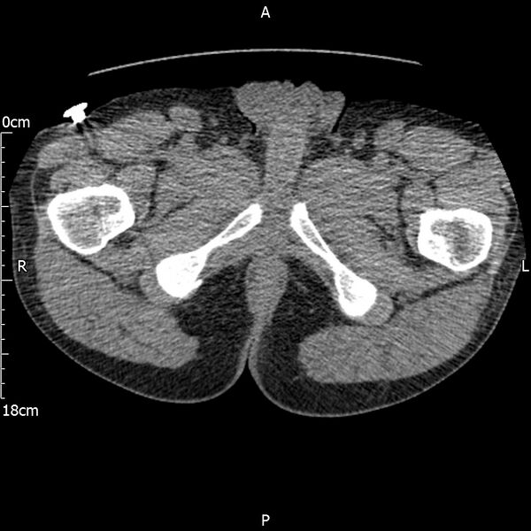 File:Bilateral medullary nephrocalcinosis with ureteric calculi (Radiopaedia 71269-81569 Axial non-contrast 145).jpg