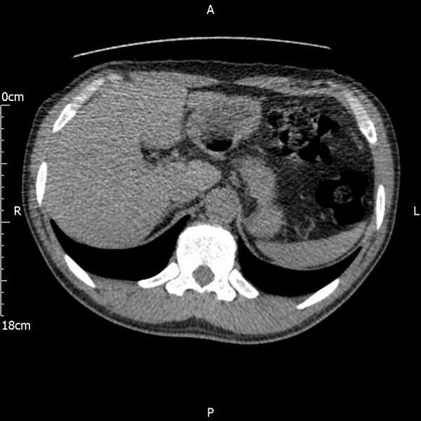 File:Bilateral medullary nephrocalcinosis with ureteric calculi (Radiopaedia 71269-81569 Axial non-contrast 20).jpg