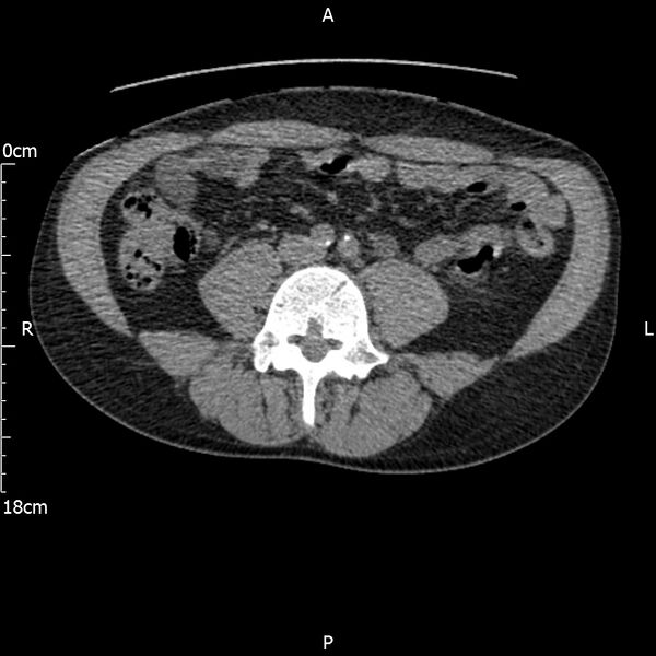 File:Bilateral medullary nephrocalcinosis with ureteric calculi (Radiopaedia 71269-81569 Axial non-contrast 76).jpg