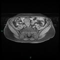 Bilateral ovarian fibroma (Radiopaedia 44568-48293 Axial T1 fat sat 5).jpg