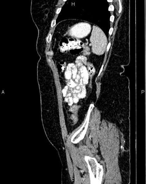 File:Bilateral ovarian serous cystadenocarcinoma (Radiopaedia 86062-101989 E 75).jpg
