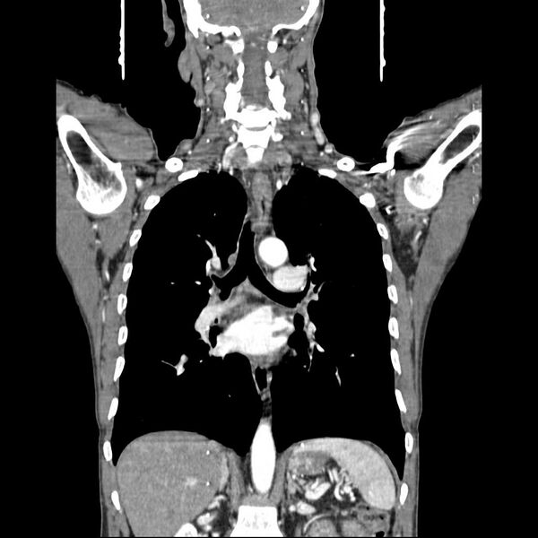 File:Bilateral parotid gland lymphoma (Radiopaedia 21038-20969 B 10).jpg