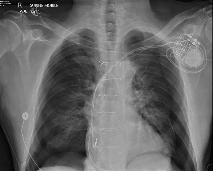 File:Bilateral pneumothoraces (Radiopaedia 78279).jpg