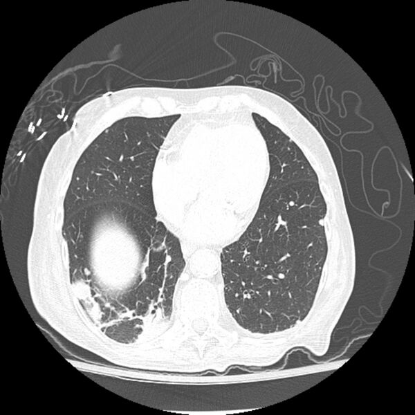 File:Bladder cancer metastases (Radiopaedia 9824-10409 Axial lung window 5).jpg