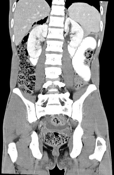 File:Blunt injury to the small bowel (Radiopaedia 74953-85987 B 66).jpg
