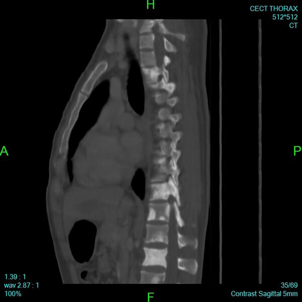 File:Bone metastases from lung carcinoma (Radiopaedia 54703-60937 Sagittal bone window 35).jpg