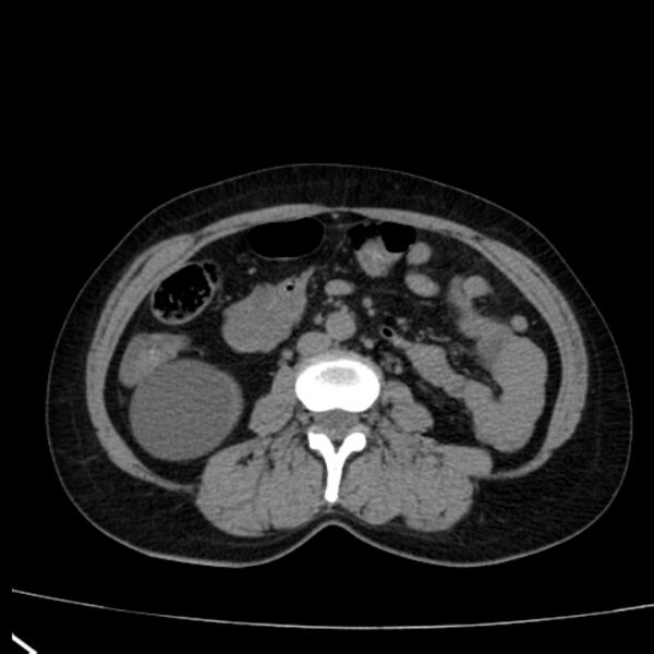 File:Bosniak renal cyst - type I (Radiopaedia 27479-27675 Axial non-contrast 48).jpg