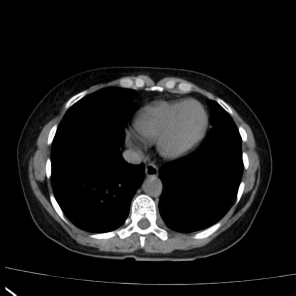 File:Bosniak renal cyst - type I (Radiopaedia 27479-27675 Axial non-contrast 5).jpg