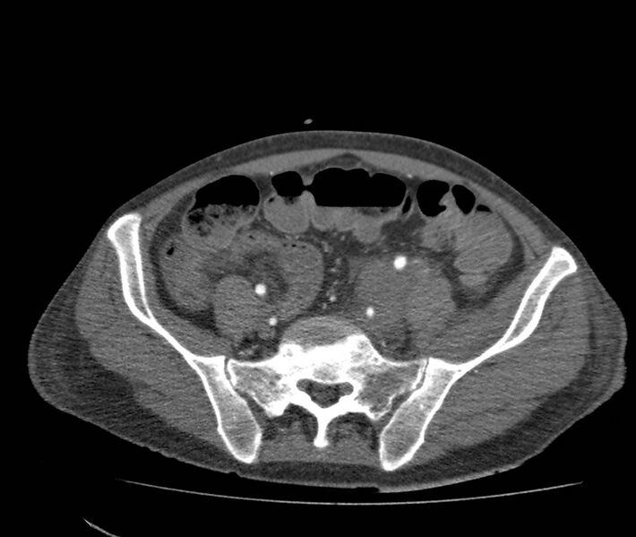 File:Bowel lymphoma complicated by bleeding after therapy (Radiopaedia 55601-62110 B 61).jpg