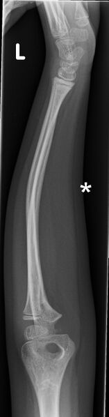 File:Bowing fracture radius and ulna (Radiopaedia 44173-47759 Lateral 1).jpg