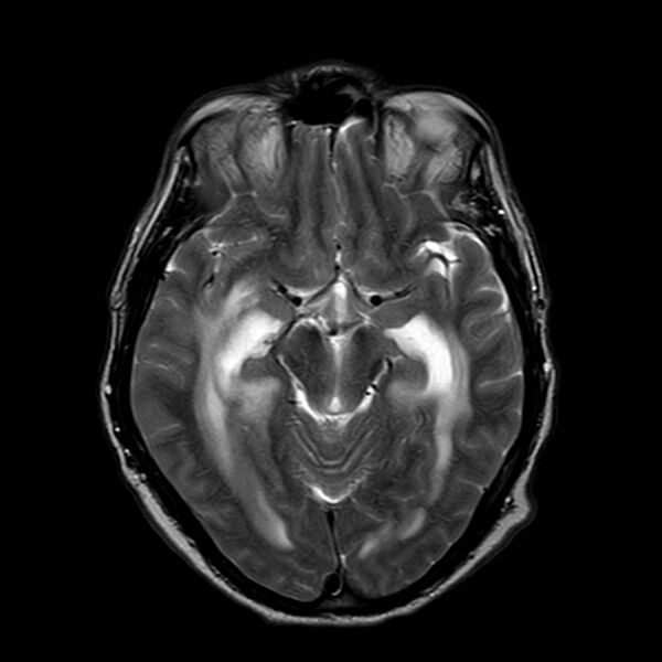 File:Brain abscess complicated by intraventricular rupture and ventriculitis (Radiopaedia 82434-96577 Axial T2 9).jpg