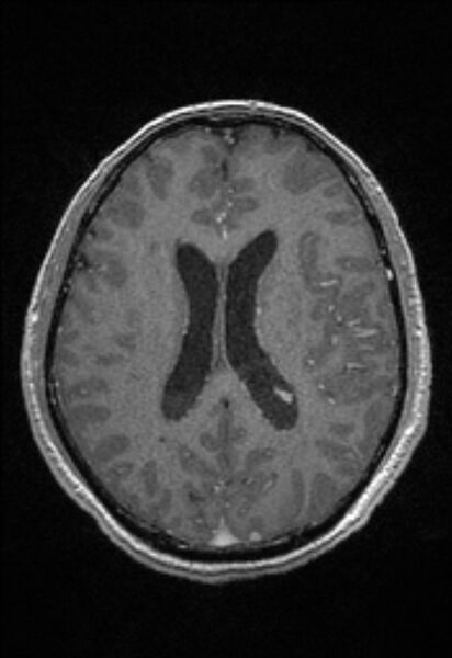 File:Brain abscess with ventriculitis (Radiopaedia 85703-101495 Axial T1 C+ 109).jpg