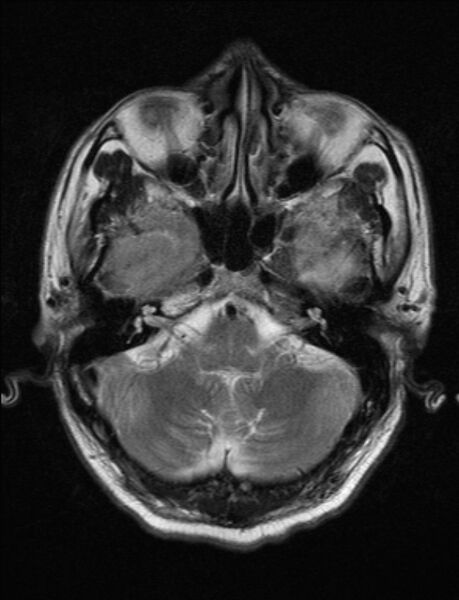 File:Brain abscess with ventriculitis (Radiopaedia 85703-101495 Axial T2 5).jpg