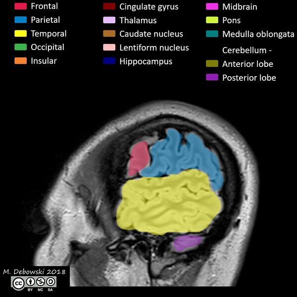 File:Brain lobes - annotated MRI (Radiopaedia 61691-69700 Sagittal 73).JPG