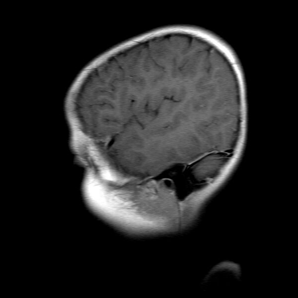 File:Brainstem ganglioglioma (Radiopaedia 10763-11224 Sagittal T1 C+ 16).jpg