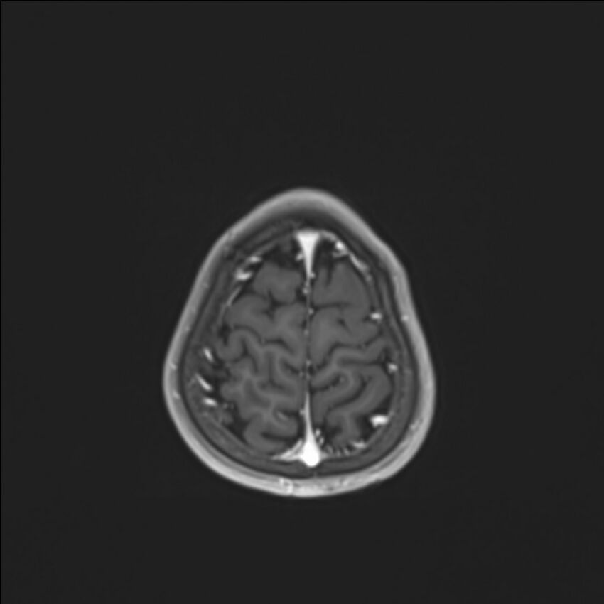 Brainstem glioma (Radiopaedia 70548-80674 Axial T1 C+ 139).jpg