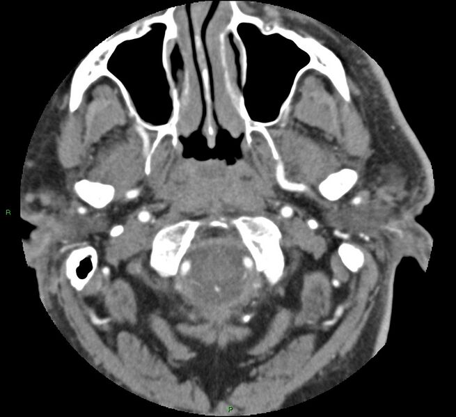 File:Brainstem hemorrhage (Radiopaedia 58794-66028 D 16).jpg