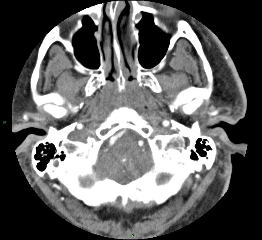 Brainstem hemorrhage (Radiopaedia 58794-66028 D 28).jpg