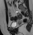 Broad ligament leiomyoma (Radiopaedia 81634-95516 Sagittal T2 20).jpg