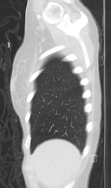 File:Bronchial atresia (Radiopaedia 73677-84470 Sagittal lung window 6).jpg