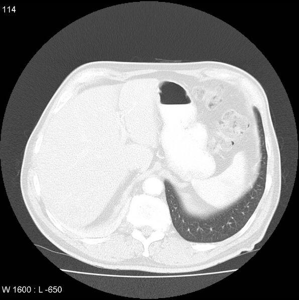 File:Bronchial carcinoid tumor with right lower lobe collapse (Radiopaedia 29060-29422 B 52).jpg