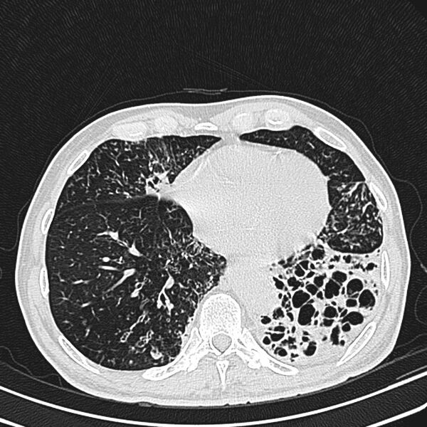 File:Bronchiectasis (Radiopaedia 22061-22059 lung window 21).jpg