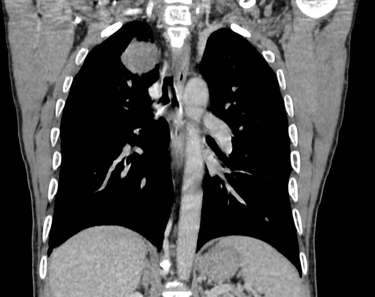 File:Bronchogenic carcinoma with superior vena cava syndrome (Radiopaedia 36497-38054 Coronal C+ delayed 66).jpg